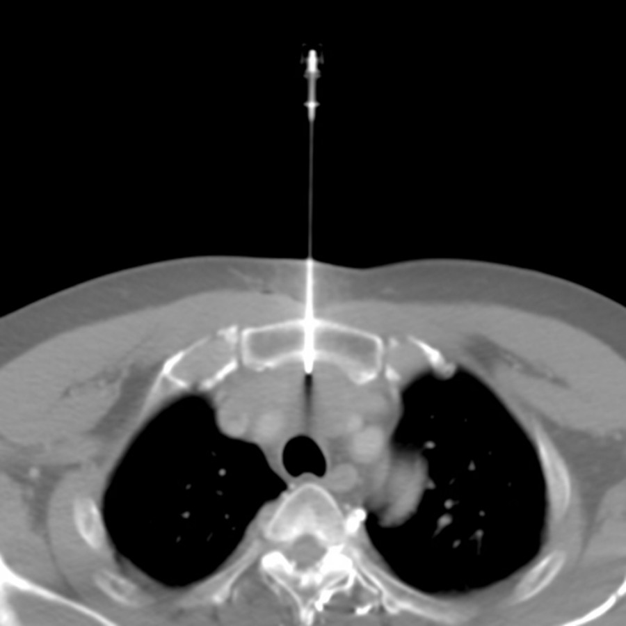 出針前確認周邊血管與氣管位置